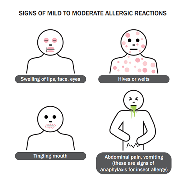 Signs of Mild Moderate Allergic Reactions