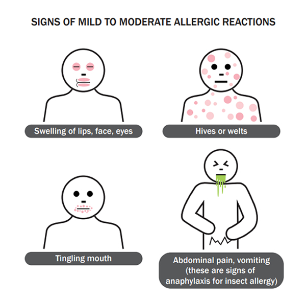 Common signs and symptoms of a mild allergic reaction